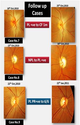 Edited picture of optic nerve head.bmp